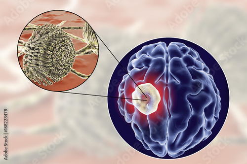 Aspergilloma of the brain and close-up view of fungi Aspergillus, 3D illustration. An intracranial lesion produced by fungi Aspergillus in immunocompromised patients photo