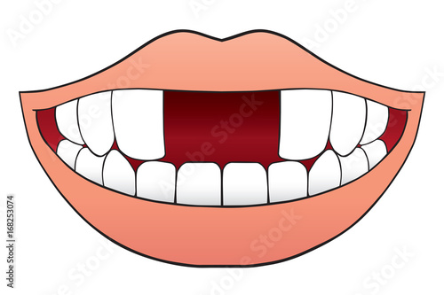 Smiling cartoon mouth is missing two front teeth