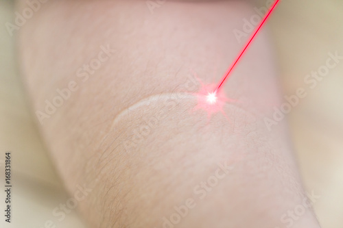 keloid or scar with laser remove technology of skin care photo