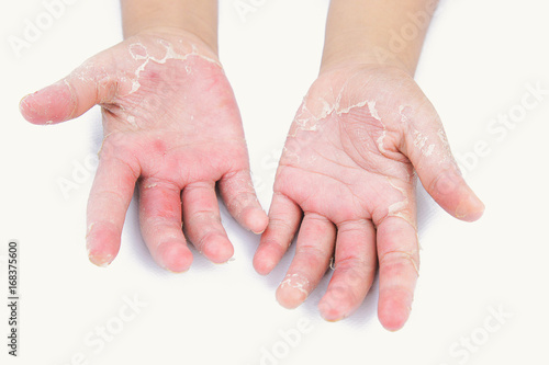 Dermatitis , Children's fingers, skin infection, severe infection. photo