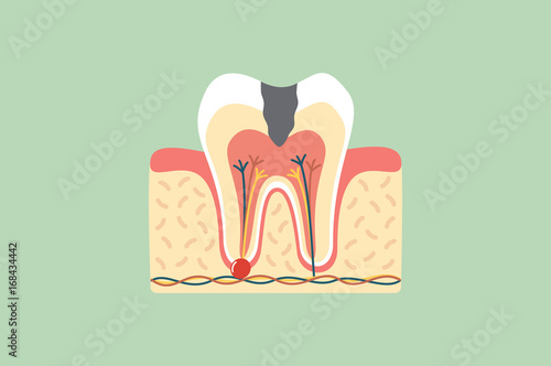 decay tooth anatomy structure including the bone and gum