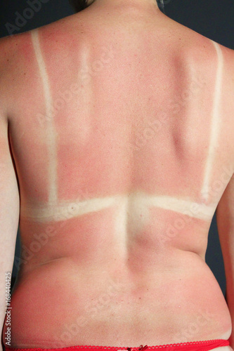 Back burnt after sunburn