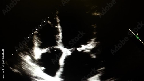 Echocardiography (ultrasound examination of the heart)
