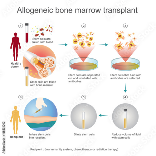 The allogeneic transplant process are donated to the person from another person, a genetically matched stem cell donor. Info graphic vector.