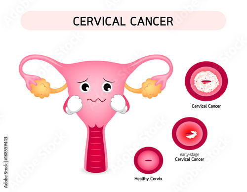 Cervical cancer diagram with sadness uterus cartoon character. Carcinoma of Cervix. Malignant neoplasm arising from cell in cervix uteri. Illustration on white background.