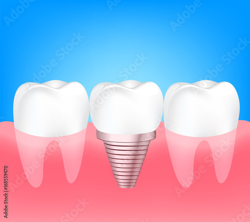 Two healthy teeth and implant tooth between. Human tooth implant concept. Illustration on blue background.