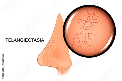 teleangiectasia, the dilation of blood vessels on the nose photo