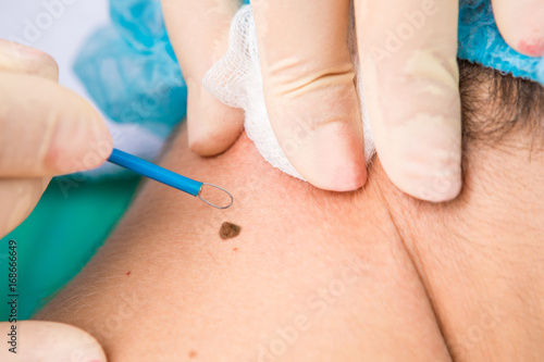Foto Medical treatment removal of the mole on the neck of the patient