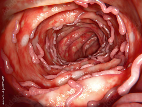 Billede på lærred Colitis ulcerosa mit massiver Pseudopolypen-Bildung