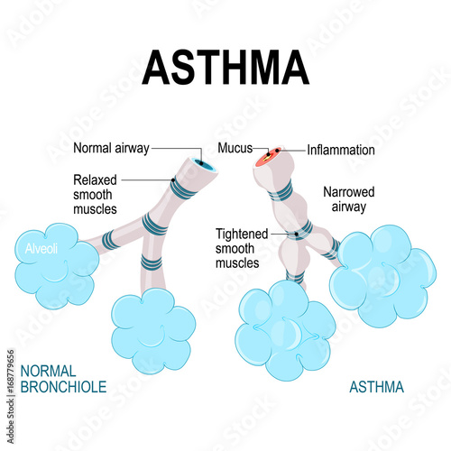 asthma. alveoli and bronchiole.
