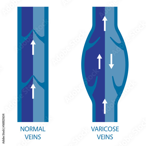 Veins. Normal vein and varicose vein. 