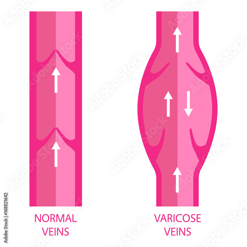 Veins. Normal vein and varicose vein. 