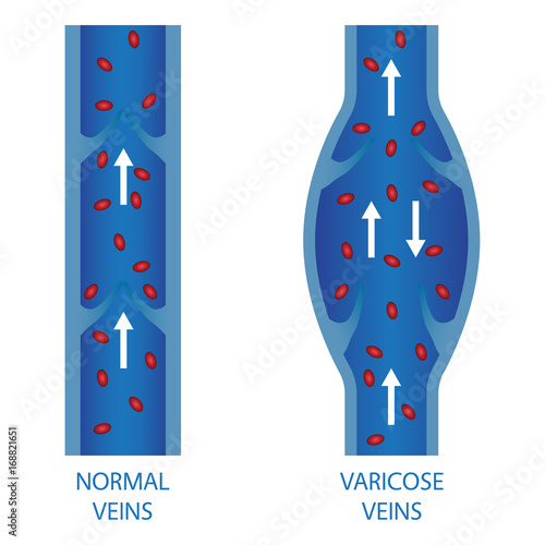 Veins. Normal vein and varicose vein. 