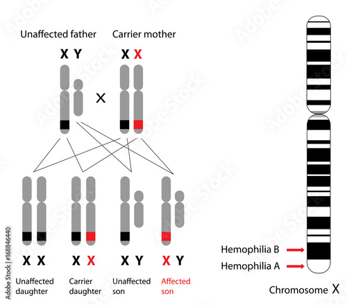 Foto Genetics of hemophilia, A and B