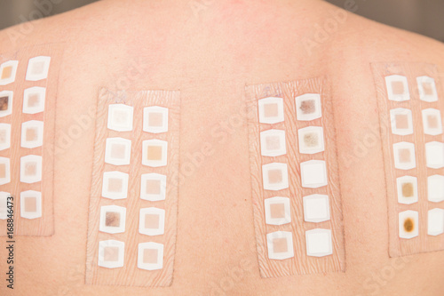Alergy patch test on the back of a young woman