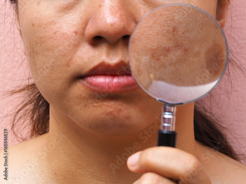 Melasma on woman face, Skin problems, unhealthy skin, Beauty and cosmetics concept