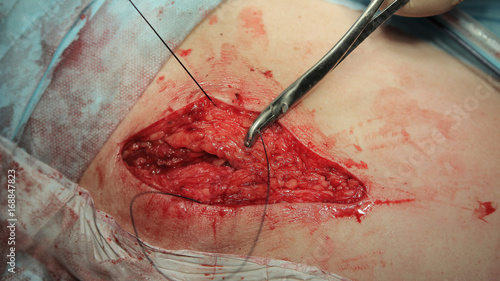 Stitching the wound with surgical wire holden by clamp close-up