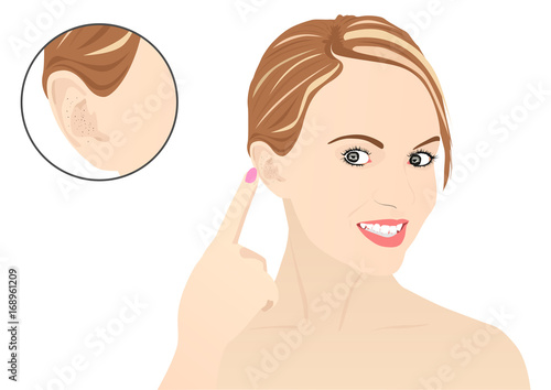 Blackheads on Ear