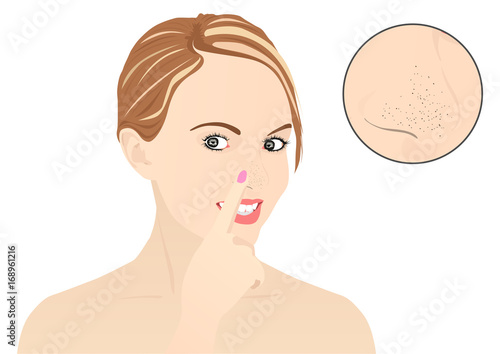 Blackheads on Nose