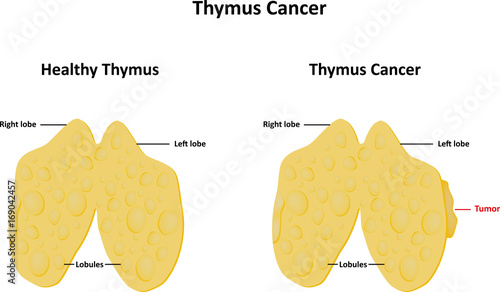 Thymus Cancer