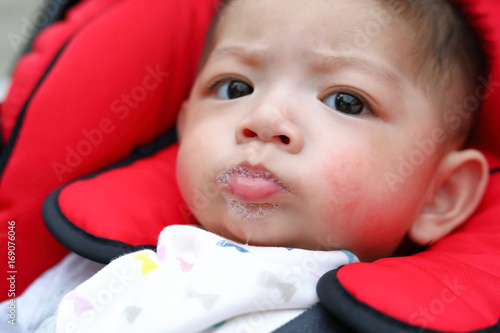 Bilde på lerret cute baby boy happy playful bubbles saliva drool on child mouth with allergic ra