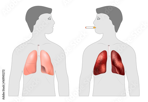 Poster about the harm of smoking. Smoker's and healthy lungs