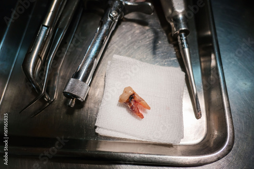 Loss of teeth from tooth extraction by the dentist. Dentistry in hospital.