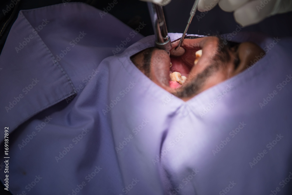 Anesthesia for tooth extraction by the dentist. Dentistry in hospital