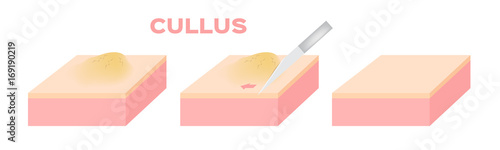 Callus Ischemic and neuropathic Diabetic Foot skin vector