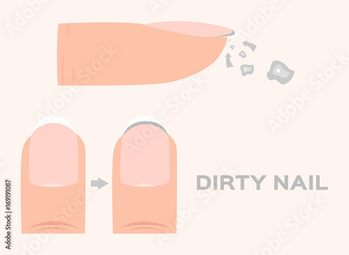 Structure of a dirty Finger Nail . human . anatomy