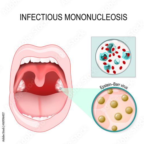 infectious mononucleosis