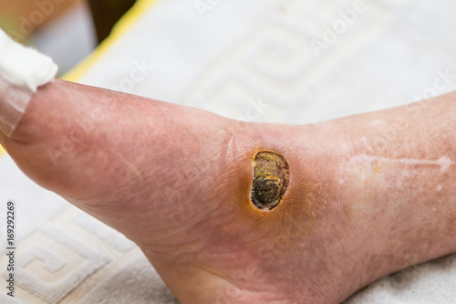 Diabetic Foot