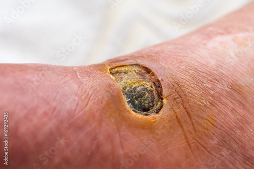 фотографія Diabetic Foot