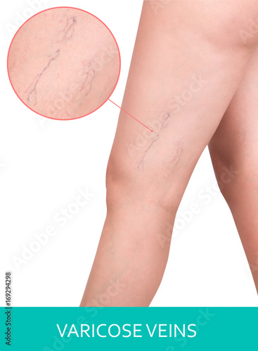 Varicose veins on the legs.