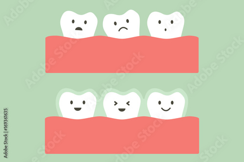 before and after teeth wear silicone trainer or invisible braces