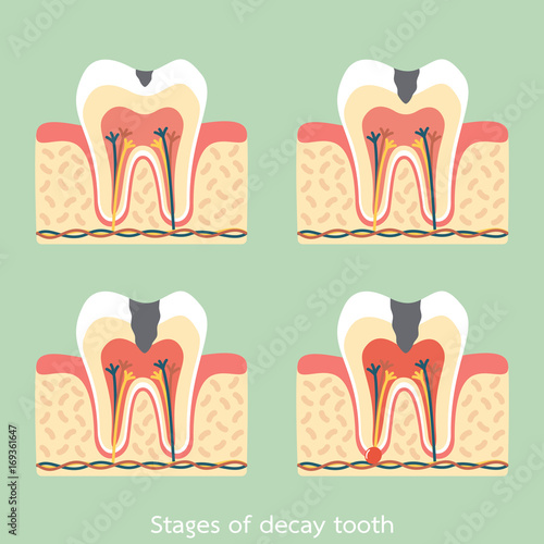 stages of decay tooth anatomy structure including the bone and gum