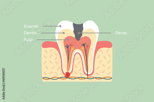 decay tooth anatomy structure including the bone and gum with detail word
