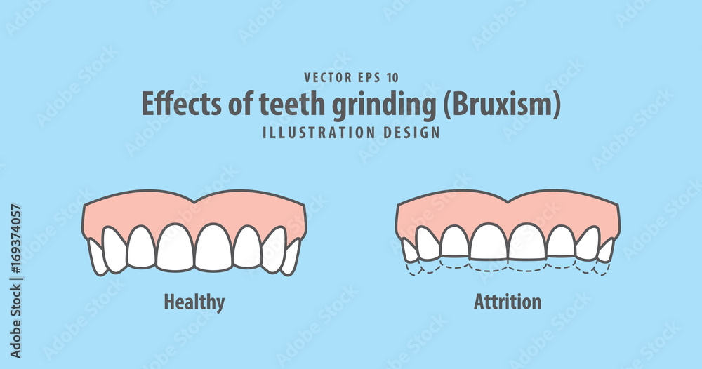 Effects of teeth grinding (Bruxism) illustration vector on blue