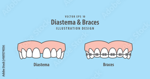 Diastema & Braces illustration vector on blue background. Dental concept.