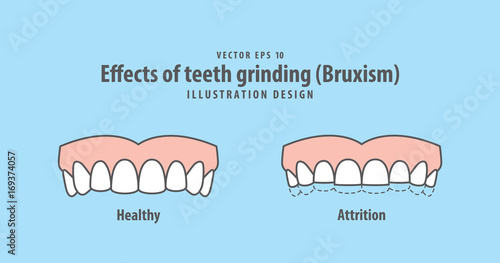 Effects of teeth grinding (Bruxism) illustration vector on blue background. Dental concept. photo