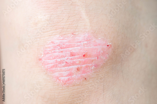 Psoriasis on the knee shows redness and applying and dry flaky skin and other dry skin conditions