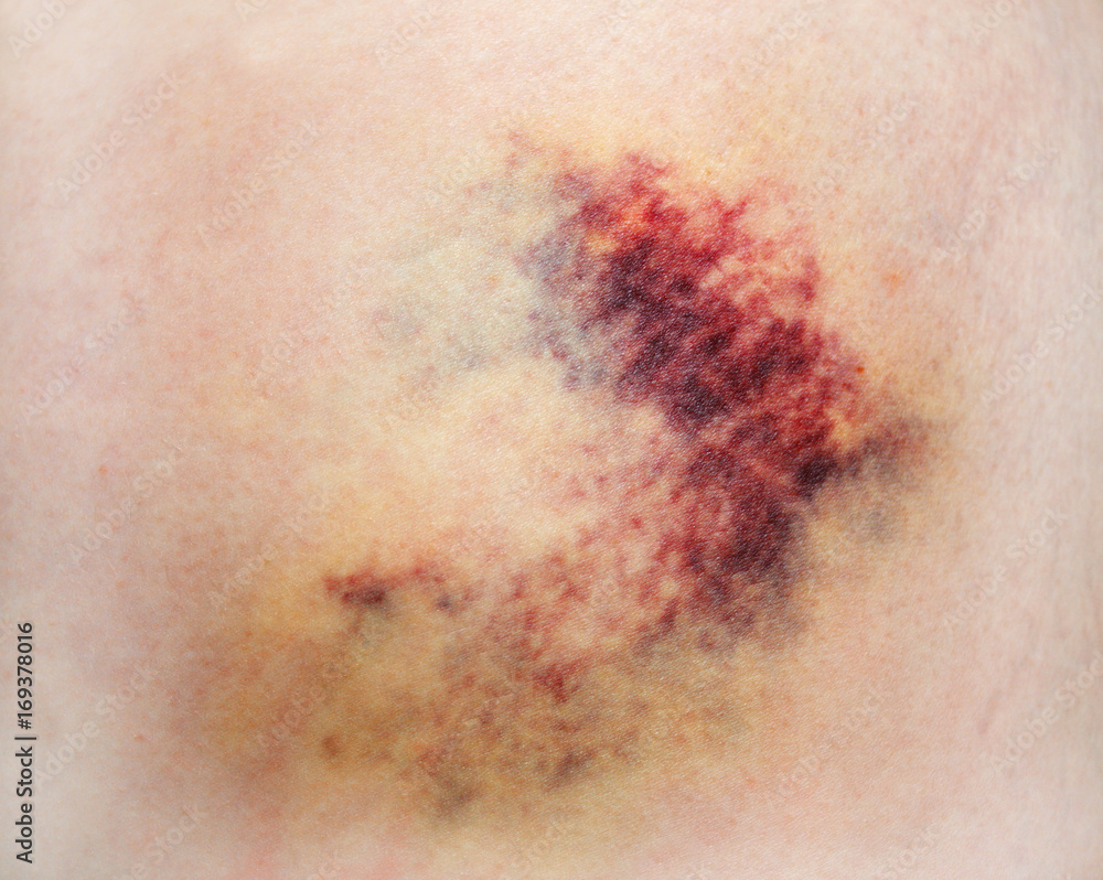 Fototapeta premium Bruise on skin