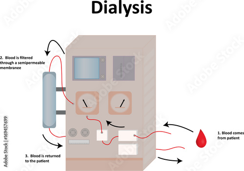 Dialysis