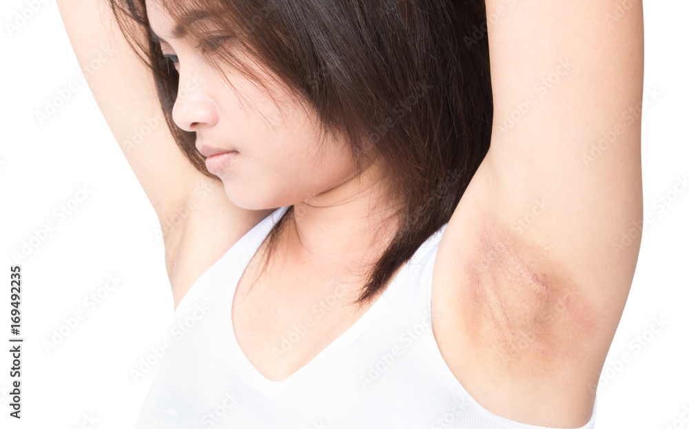 Women problem black armpit on white background for skin care and beauty concept Women problem black armpit on white background for skin care and beauty concept