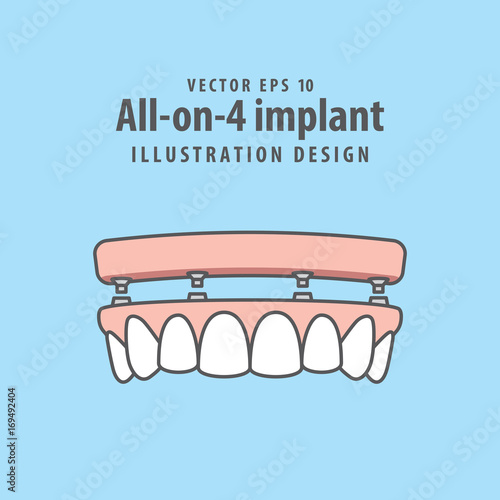 All-on-4 implant illustration vector on blue background. Dental concept.