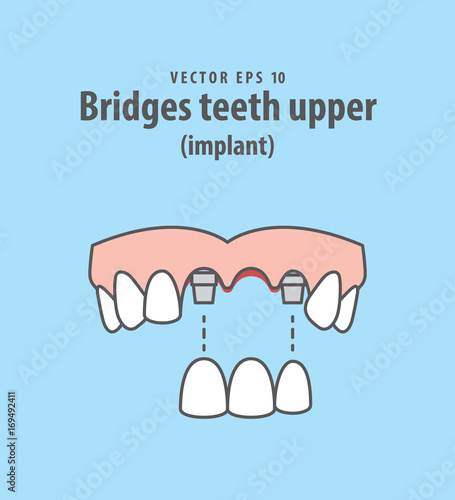 Bridges teeth upper (implant) illustration vector on blue background. Dental concept.