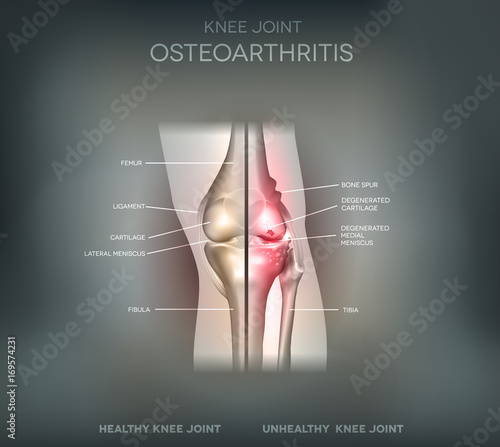 Joint problems osteoarthritis, healthy joint and damaged joint illustration