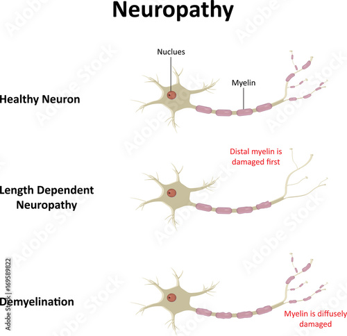 Neuropathy