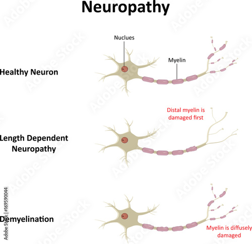 Neuropathy photo
