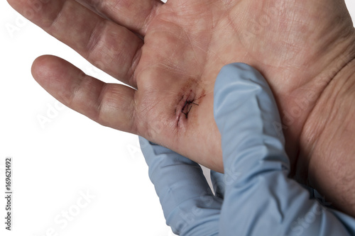 A hand with stiches being assessed 